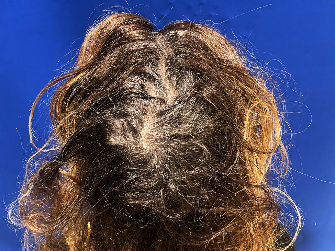 Hair restoration for woman